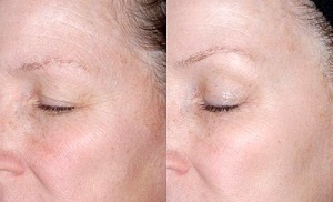 فوٹو سے پہلے اور بعد میں آنکھوں کے گرد جلد کی بحالی