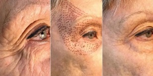پلازما جلد کی بحالی سے پہلے اور بعد کی تصاویر